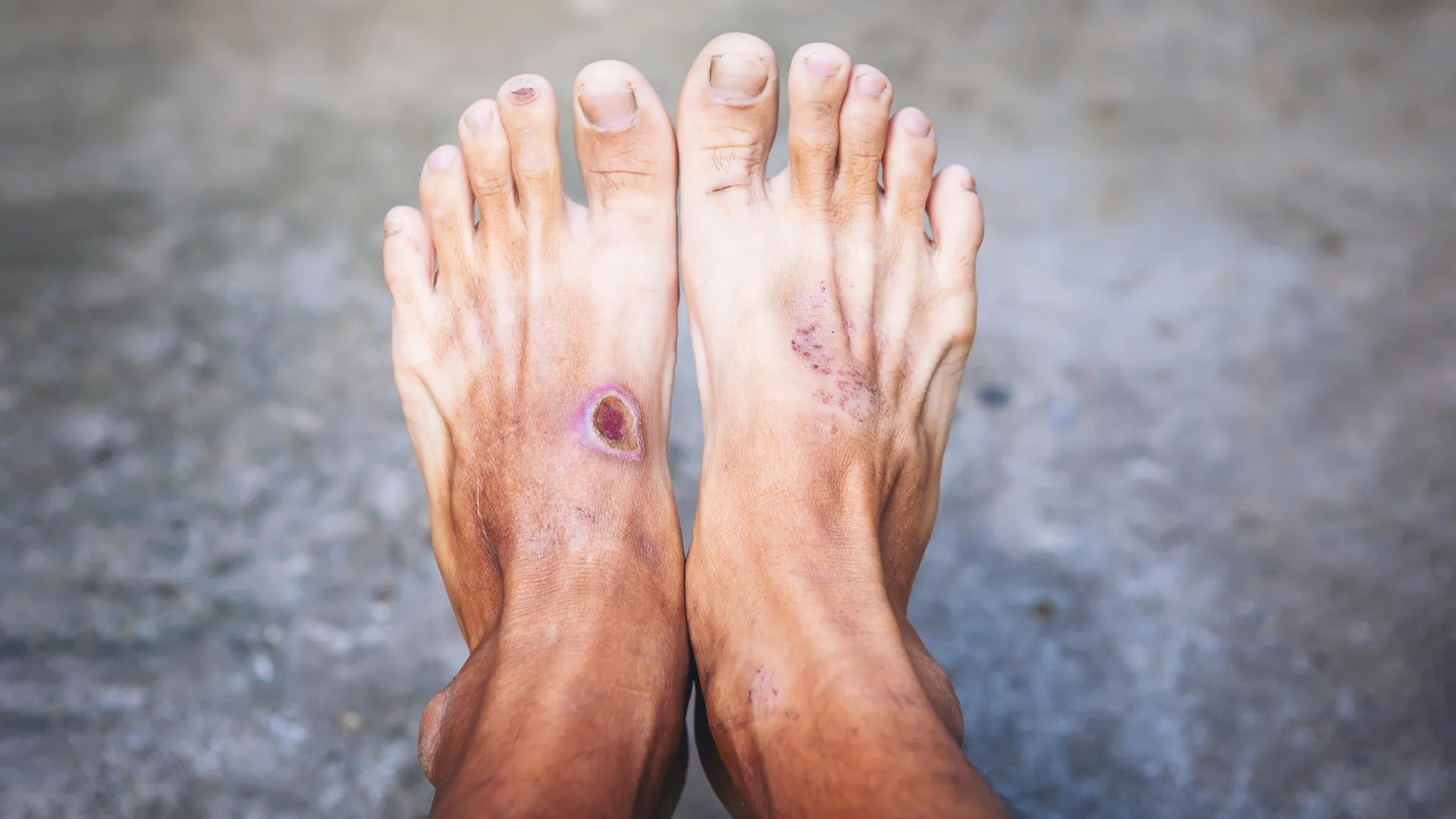 Why Do Diabetic Wounds Heal Slowly? Scientists Find Important Clues