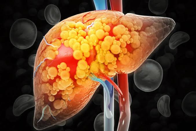 Dr. Vaidya Finds Fatty Liver Disorder in One Out of Three Indians