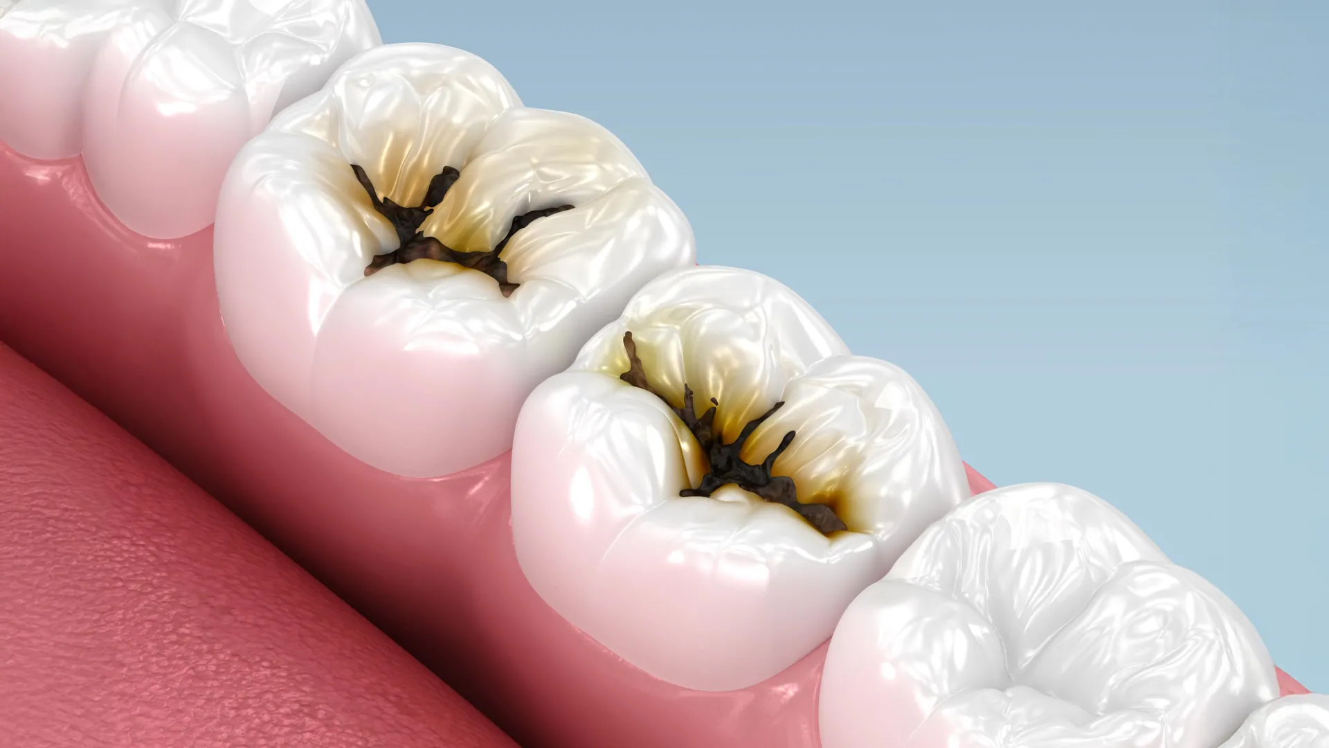 Painting Over Decay: Pain-Free Liquid Liquid Treatment Stops Cavities in Children Without Drilling