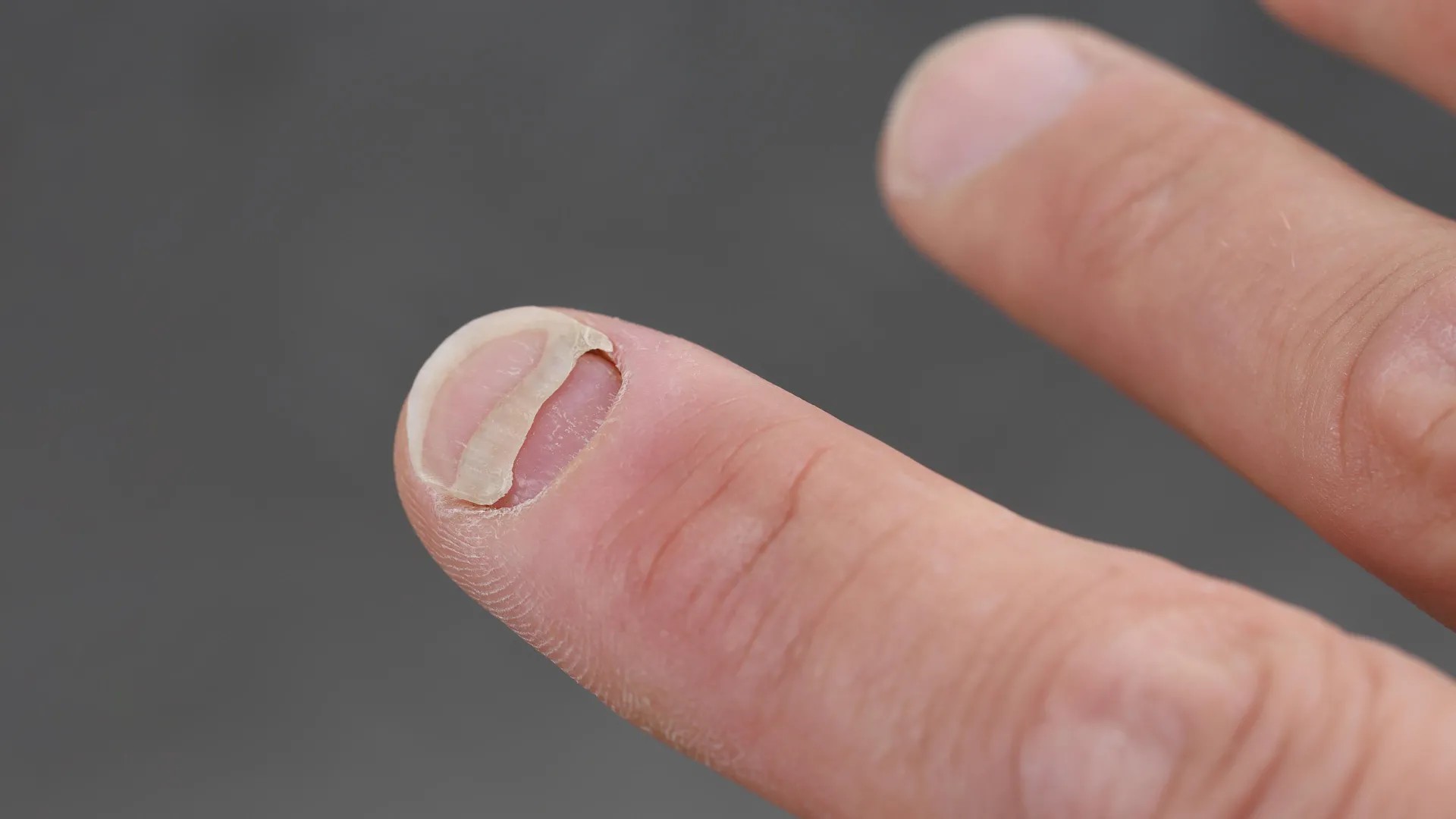 The Hidden Side Effect: Popular GLP-1 Weight Loss Drugs Linked to Nail and Scalp Issues