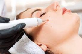 Skin Tag & Mole Removal