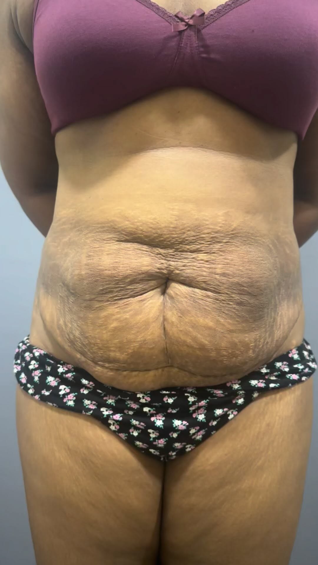 Before & After Results