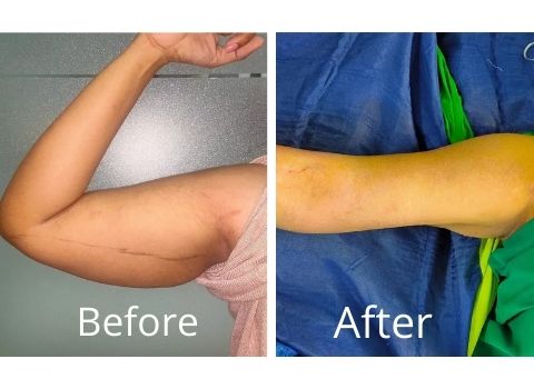 Arm Lift Surgery