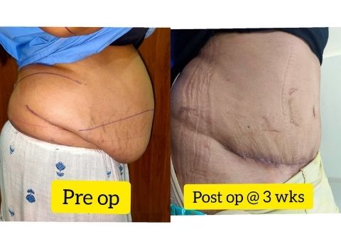 Abdominoplasty: Right view