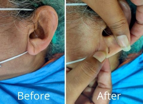Ear Lobe Surgery: Left Ear