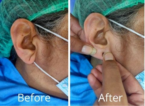 Ear Lobe Surgery: Right Ear