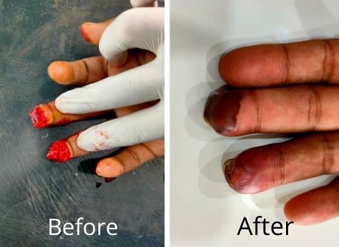 Finger tip reconstruction