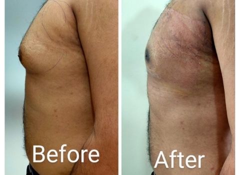 Gynecomastia: Left view