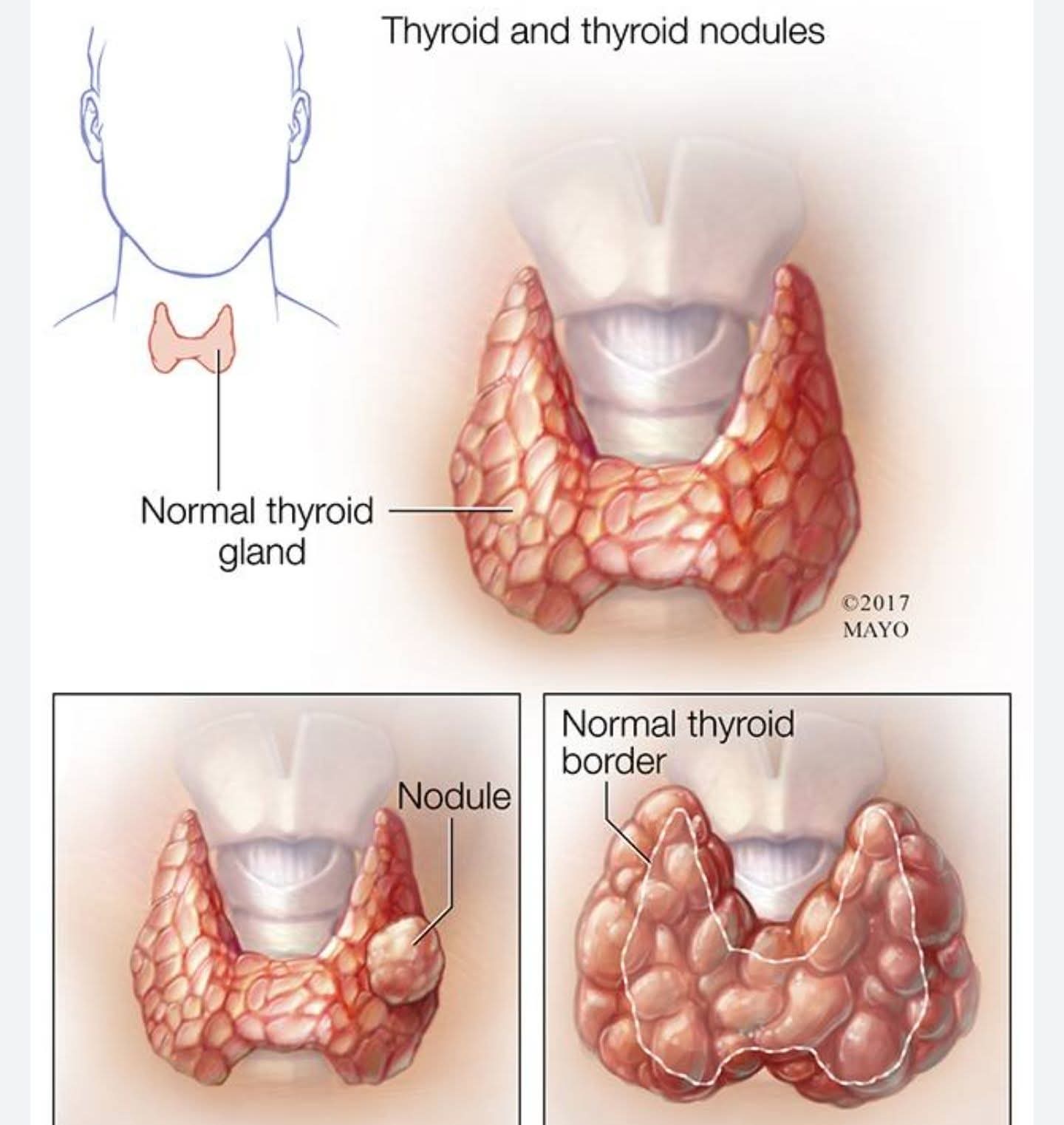 Tiroida nu se dereglează singură