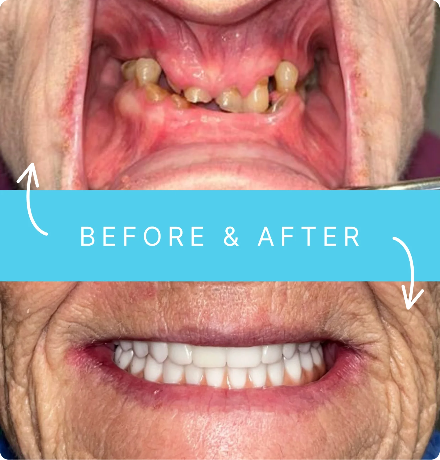 Before - Missing and discolored teeth