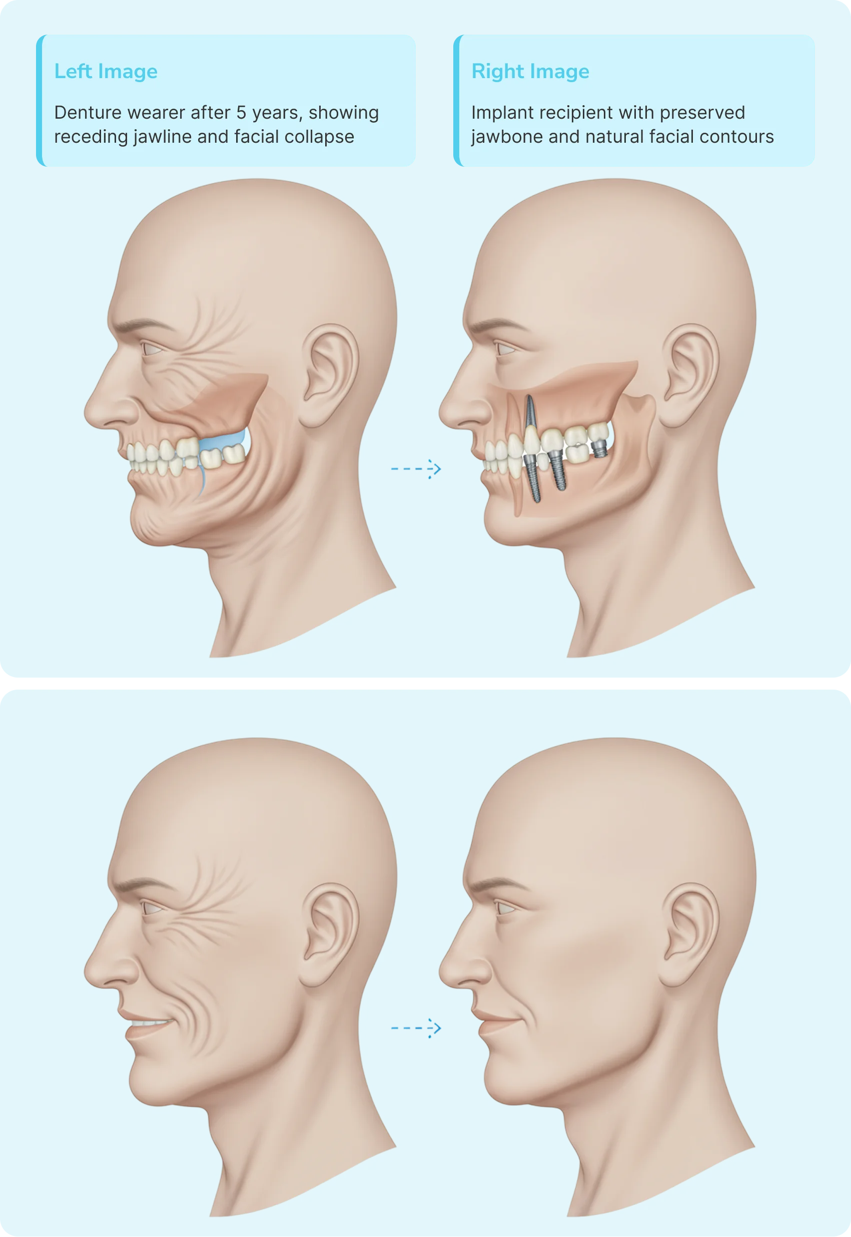 Implant recipient with preserved jawbone