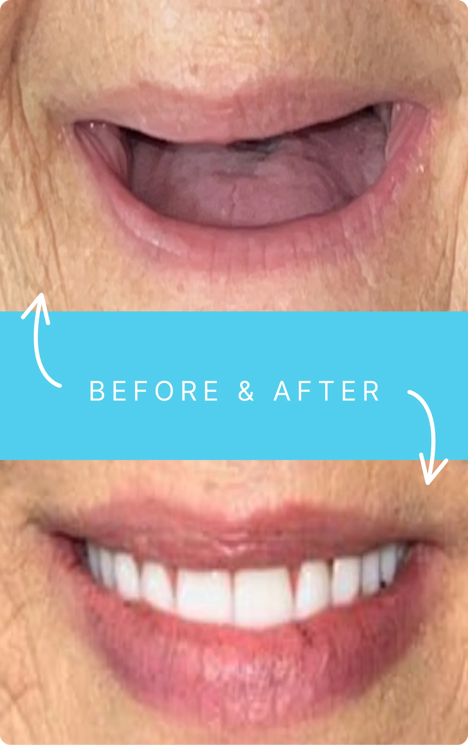 Before - No teeth, only gums