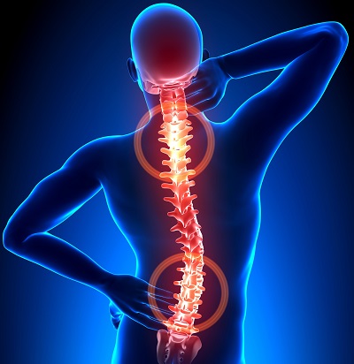 Scoliosis Scoliosis