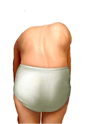 Scoliosis Scoliosis