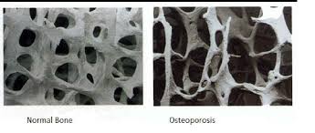 Strengthen your bones: Resistance training can help prevent osteoporosis