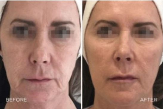 Före och efter Profhilo Före och efter Profhilo