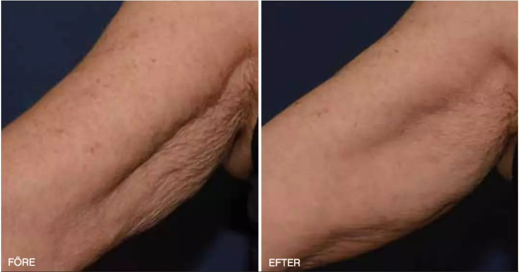 Före och Efter Profhilo armar Före och Efter Profhilo armar