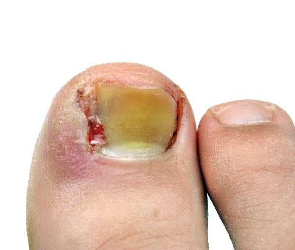 Nail Surgery and Curing an Ingrown Toenail in the High Peak and Derbyshire  Dales – Care For Feet