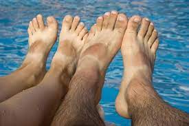 We Fix Feet - Sunburnt feet
