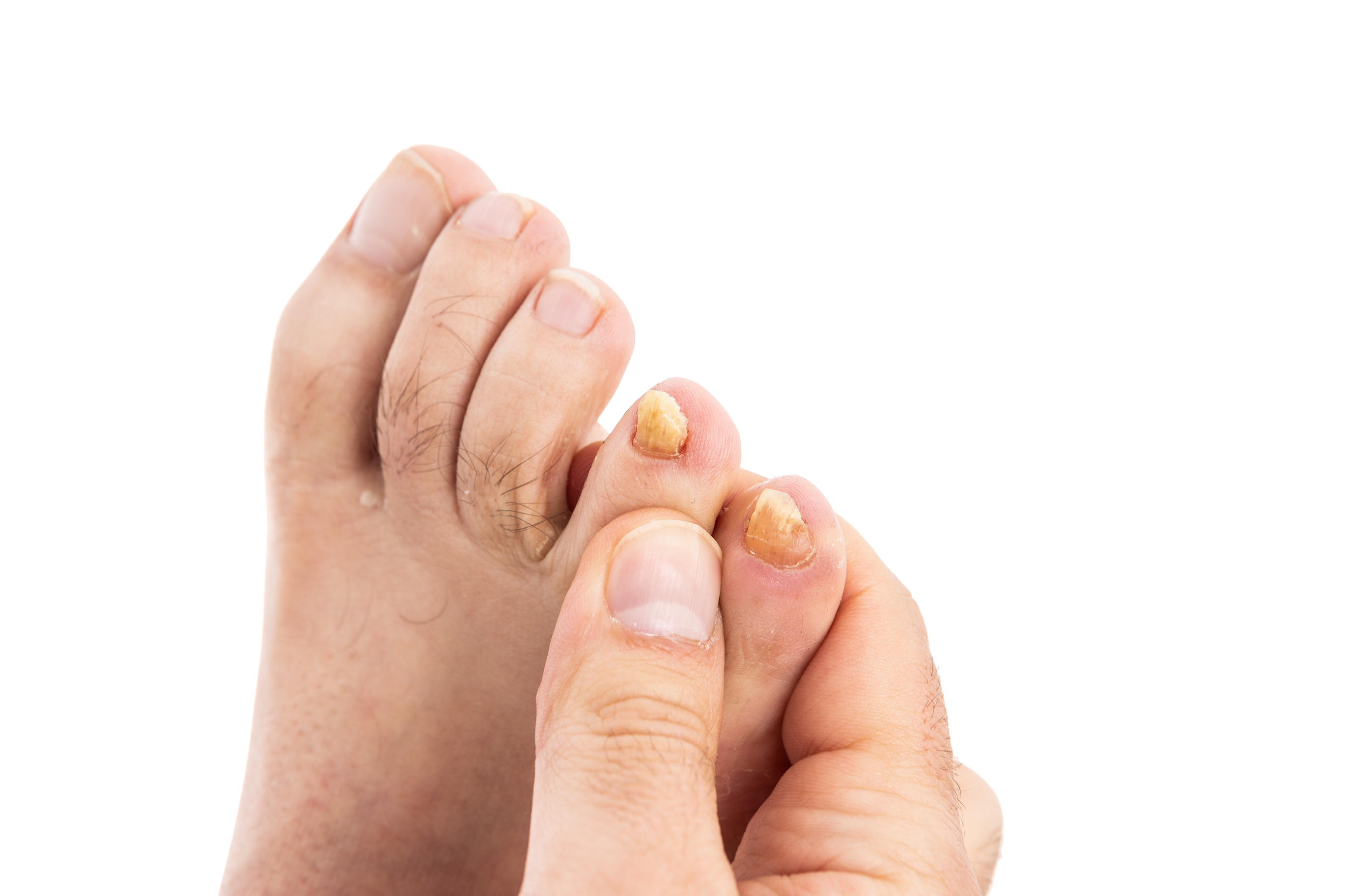 Fungal Nails. We Fix Feet, Beeston and Ilkeston