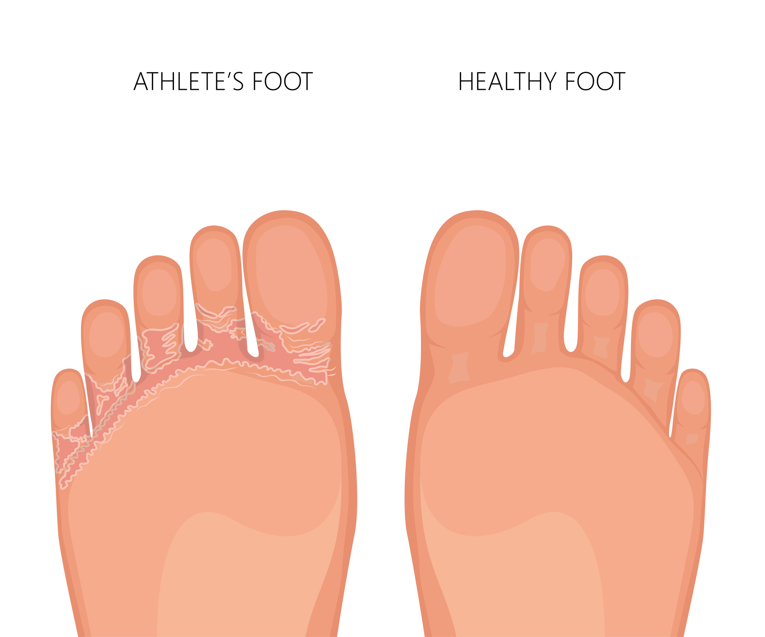 Athletes foot. We Fix Feet, Ilkeston and Beeston