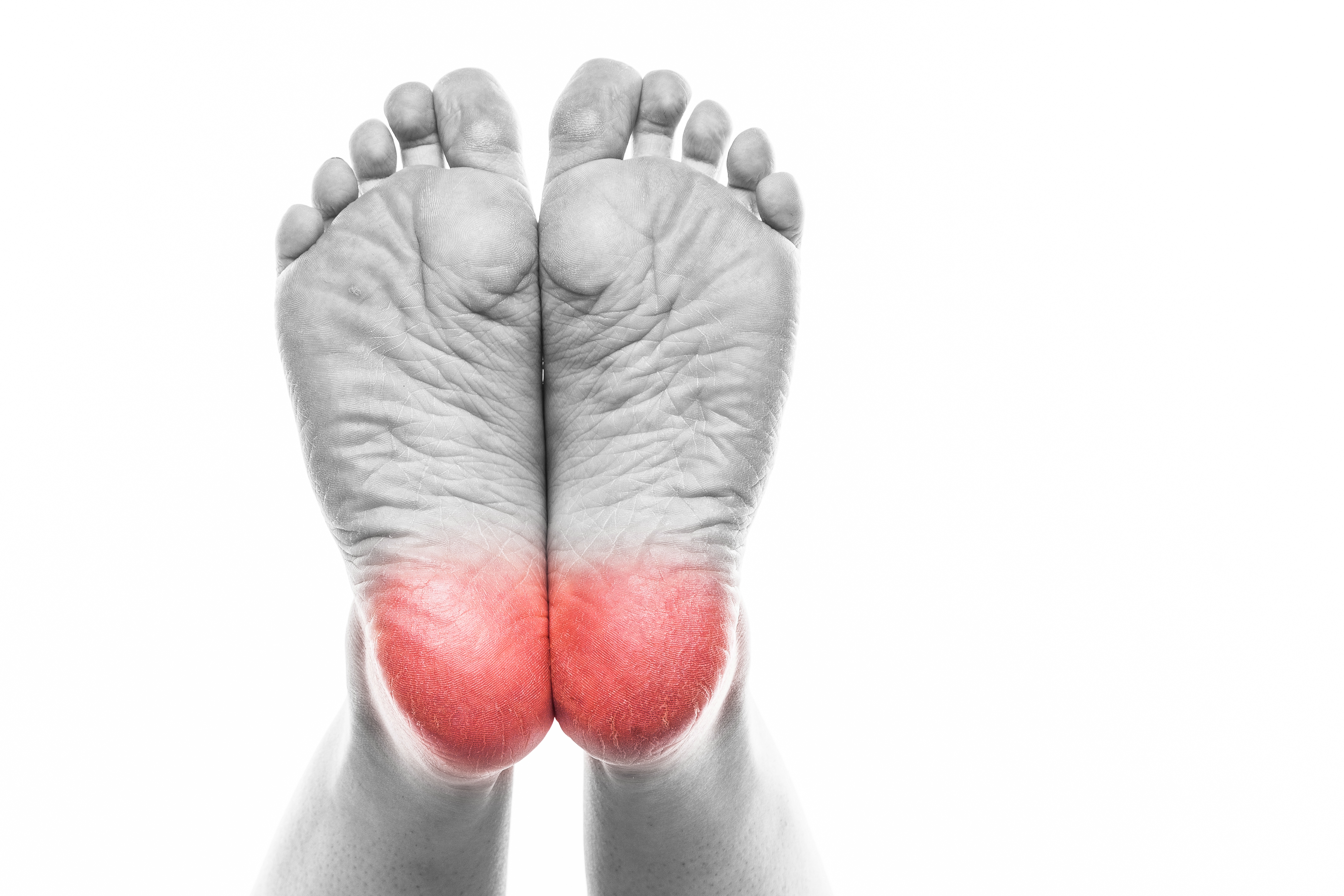 Heel Pain, how do we fix it? We Fix Feet, Beeston and Ilkeston.