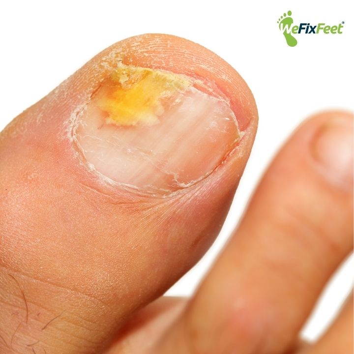 Fungal nail. We Fix Feet, Ilkeston and Beeston