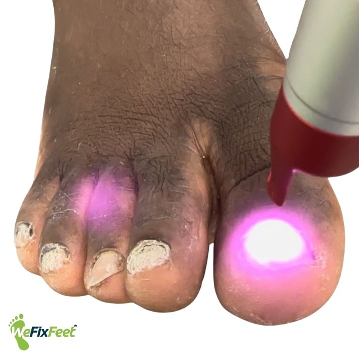 Laser treatment for fungal nails. We Fix Feet, Beeston and Ilkeston.