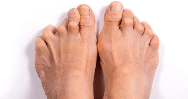 Rheumatoid Athritis, Biomechanix Clinic Coventry Foot Doctor