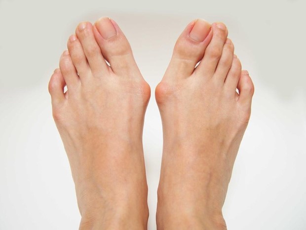 Bunion, bump on side of big toe, painful toe, Biomechanix Clinic - Coventry Foot Doctor