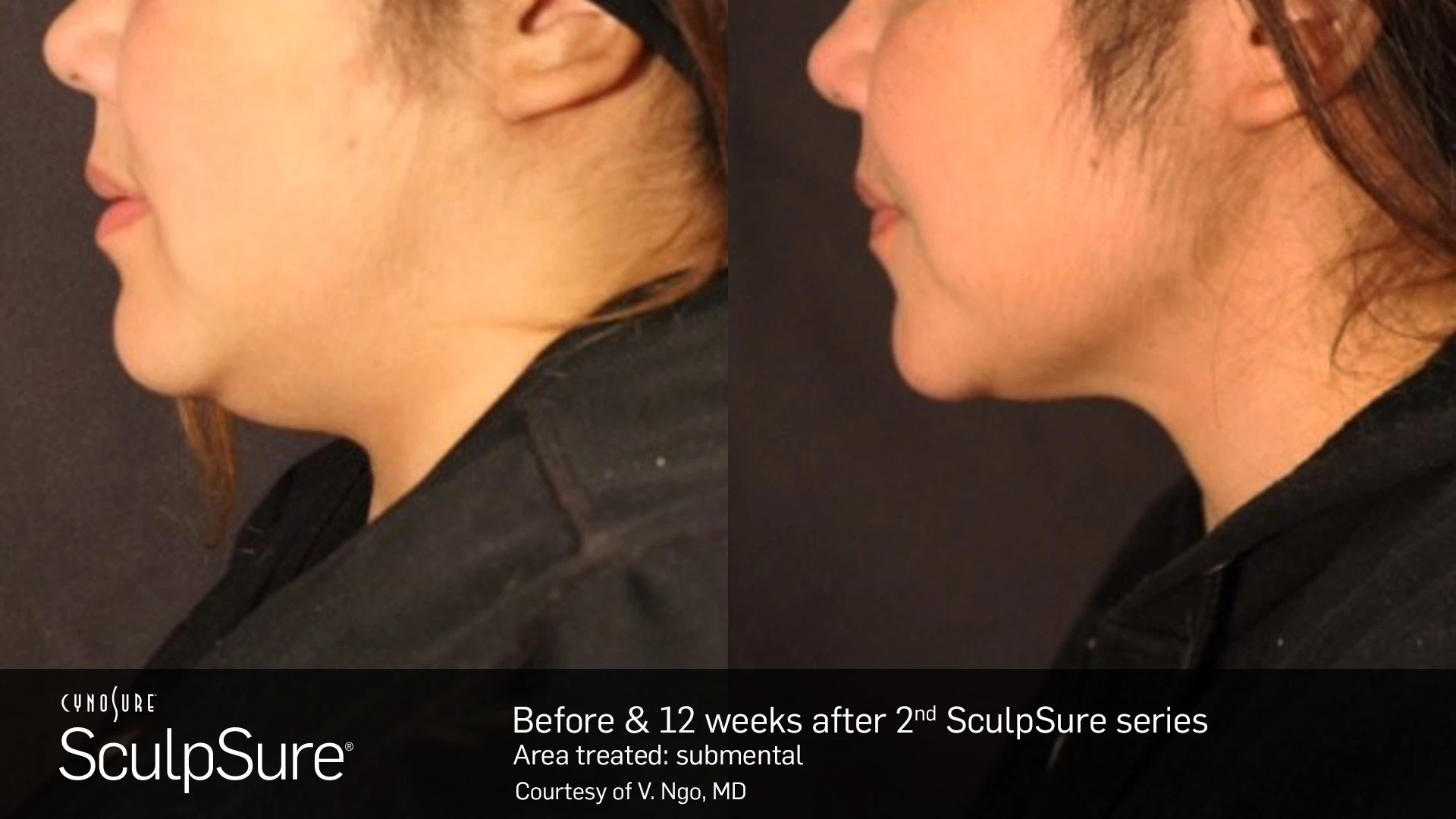 Before and After