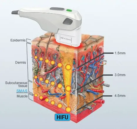 HIFU Technology - How it targets different skin layers at 1.5mm, 3.0mm, and 4.5mm depths