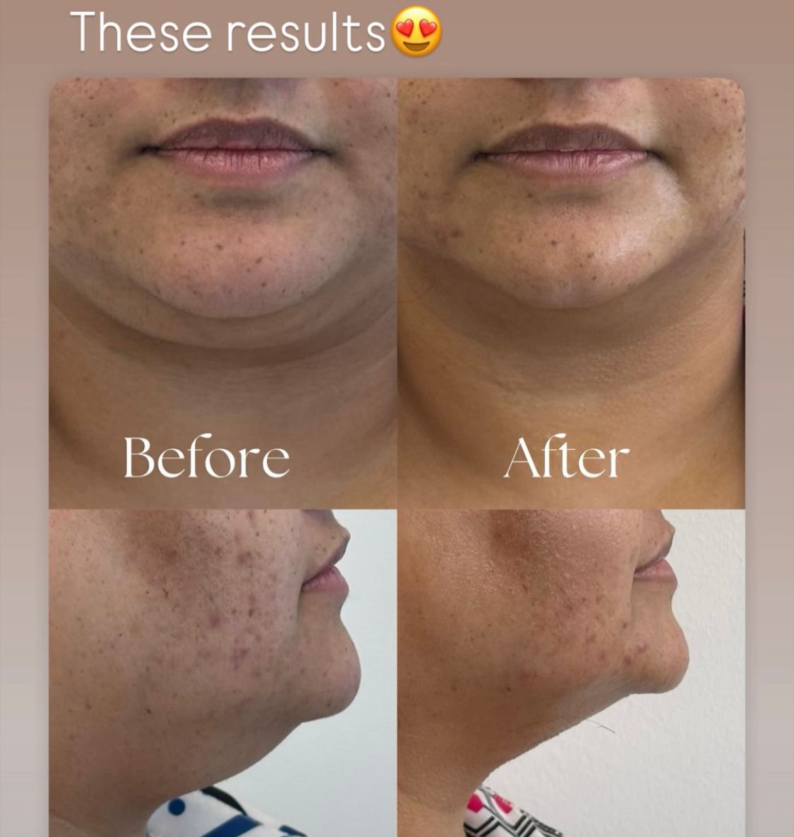 HIFU Before and After - Jawline Definition & Neck Tightening