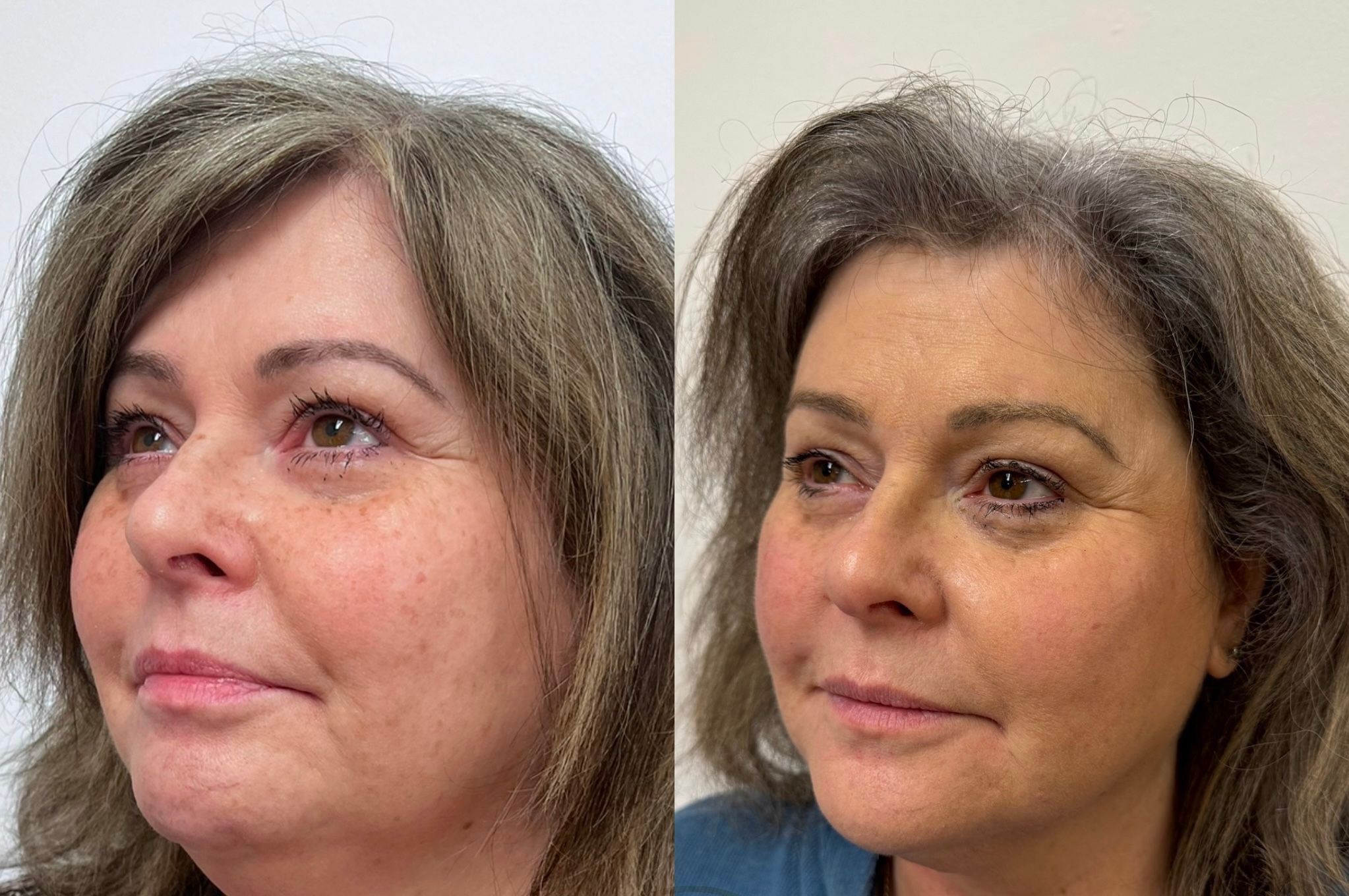 HIFU Before and After - Complete Transformation