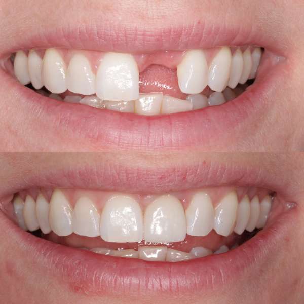 Proceso de colocación de implante dental