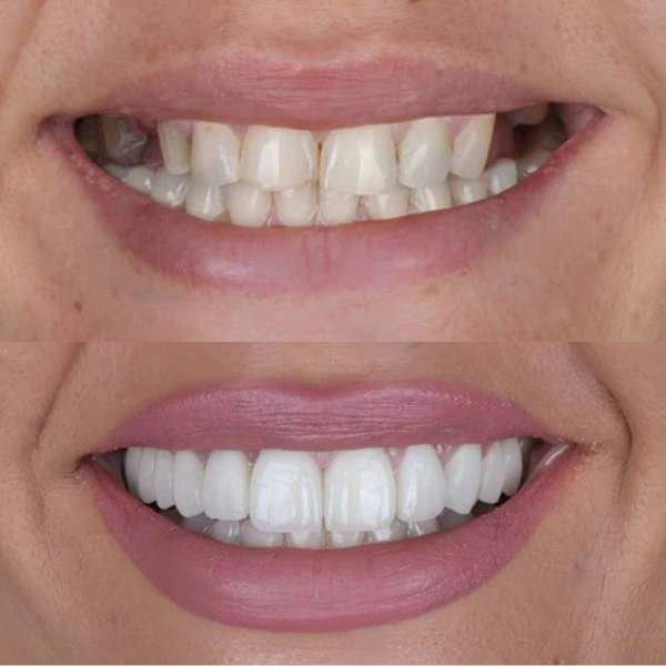 Primer plano de un implante dental de alta calidad