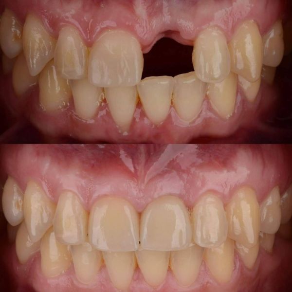 Paciente sonriendo después de un implante dental