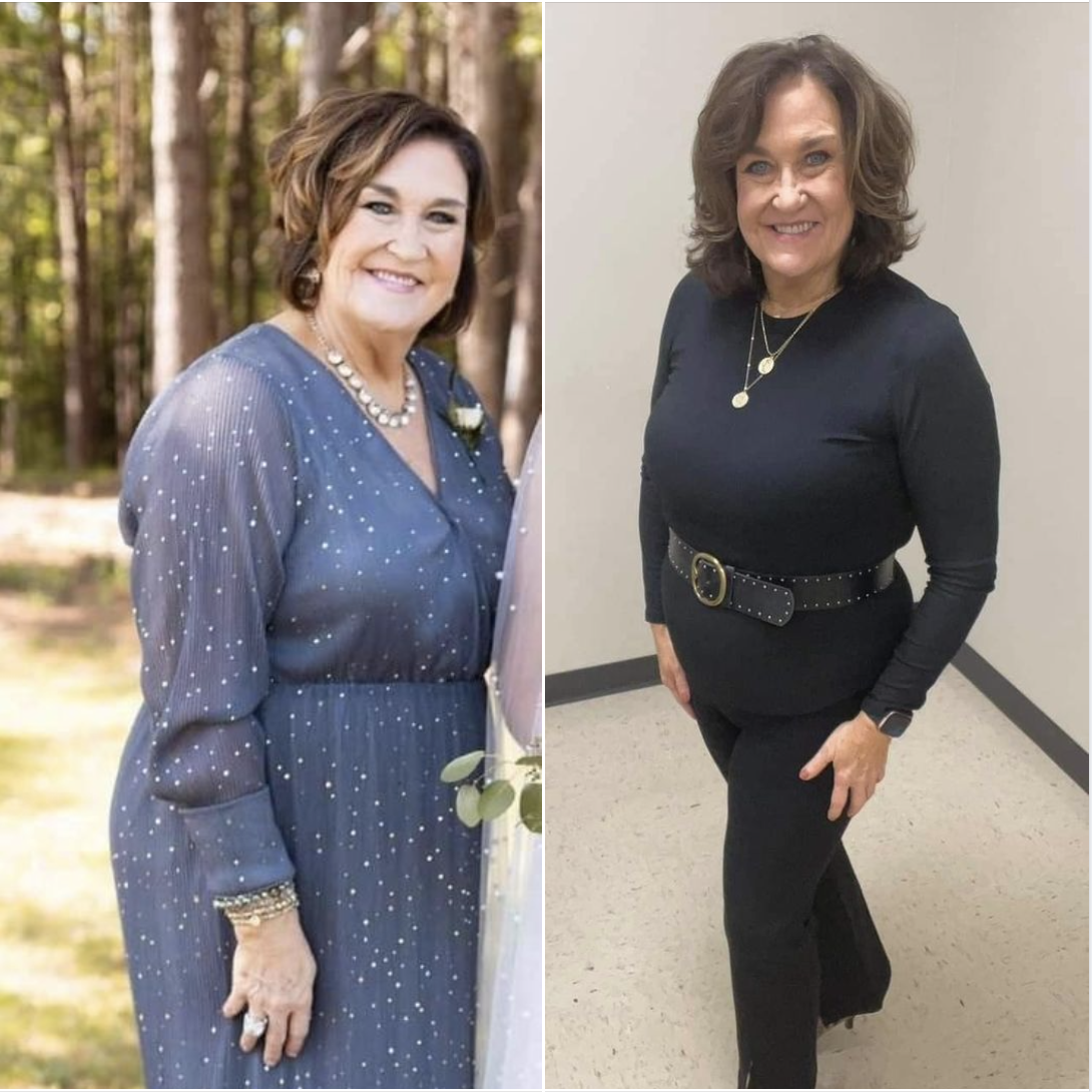 Avant / après Slimming 10