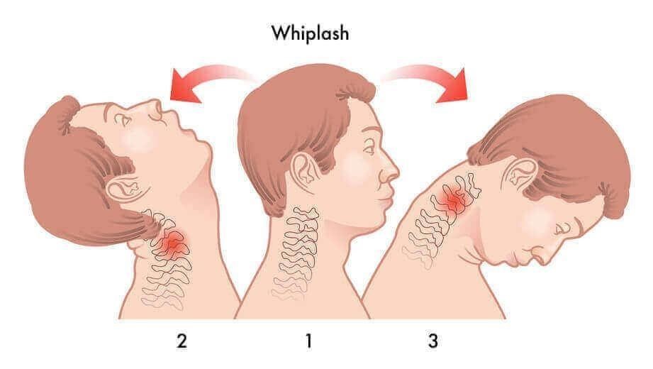 Common causes of whiplash