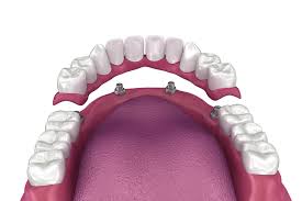 The True Lifetime Cost of Tooth Loss: Why Dental Implants at Osuna Dental Care Are the Most Affordable Long-Term Solution in Albuquerque