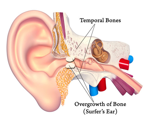 Surfer's Ear Diagram Surfer's Ear Diagram