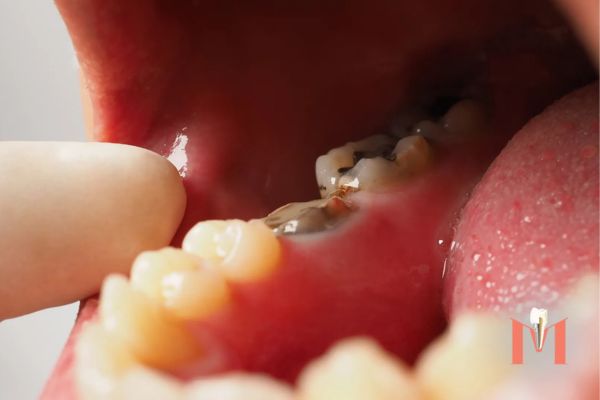mountcrest-dental-hamilton-damaged-teeth-restoration mountcrest-dental-hamilton-damaged-teeth-restoration