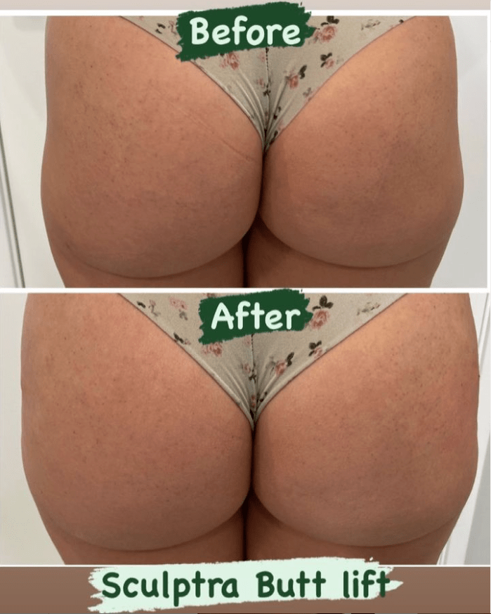 sculptra-bbl-before-and-after sculptra-bbl-before-and-after