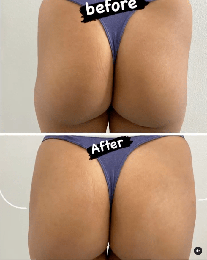 Sculptra BBL before and after Sculptra BBL before and after