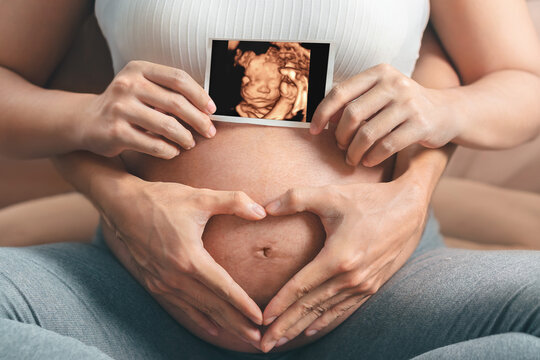 3D Ultrasound Atlanta - 4D Ultrasound in Atlanta - HD Ultrasound