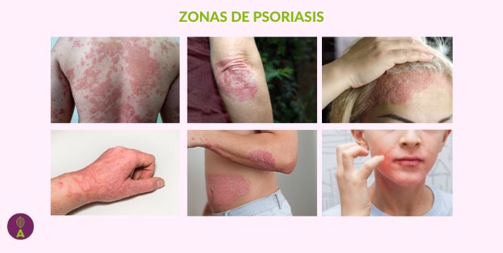 Psoriasis afecta a todas las zonas del cuerpoDescubre en este artículo cómo recuperar una piel sana