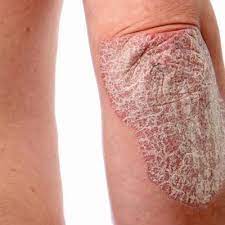 la psoriasis de este tipo puede ser causa de depresión Piel Sana