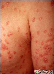 Psoriasis guttata 1 d elas diferente sformas de psoriasis Piel sana