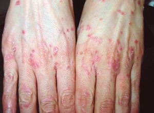 Psoriasis