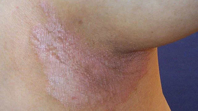Psoriasis
